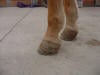Club Foot